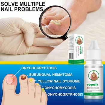 SUAI Масло за лечение на гъбички на ноктите Repair Foot Essence Гел за премахване на гъбички на ноктите на краката Противоинфекционный Крем за премахване на гъбички на ноктите на краката 20 мл