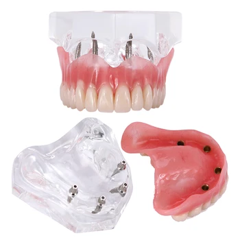 Стоматологичен модел на зъбите с прозрачни горните 4 импланти, модел за възстановяване на зъбната протеза за зъболекар, обяснява функционирането на зъбната протеза